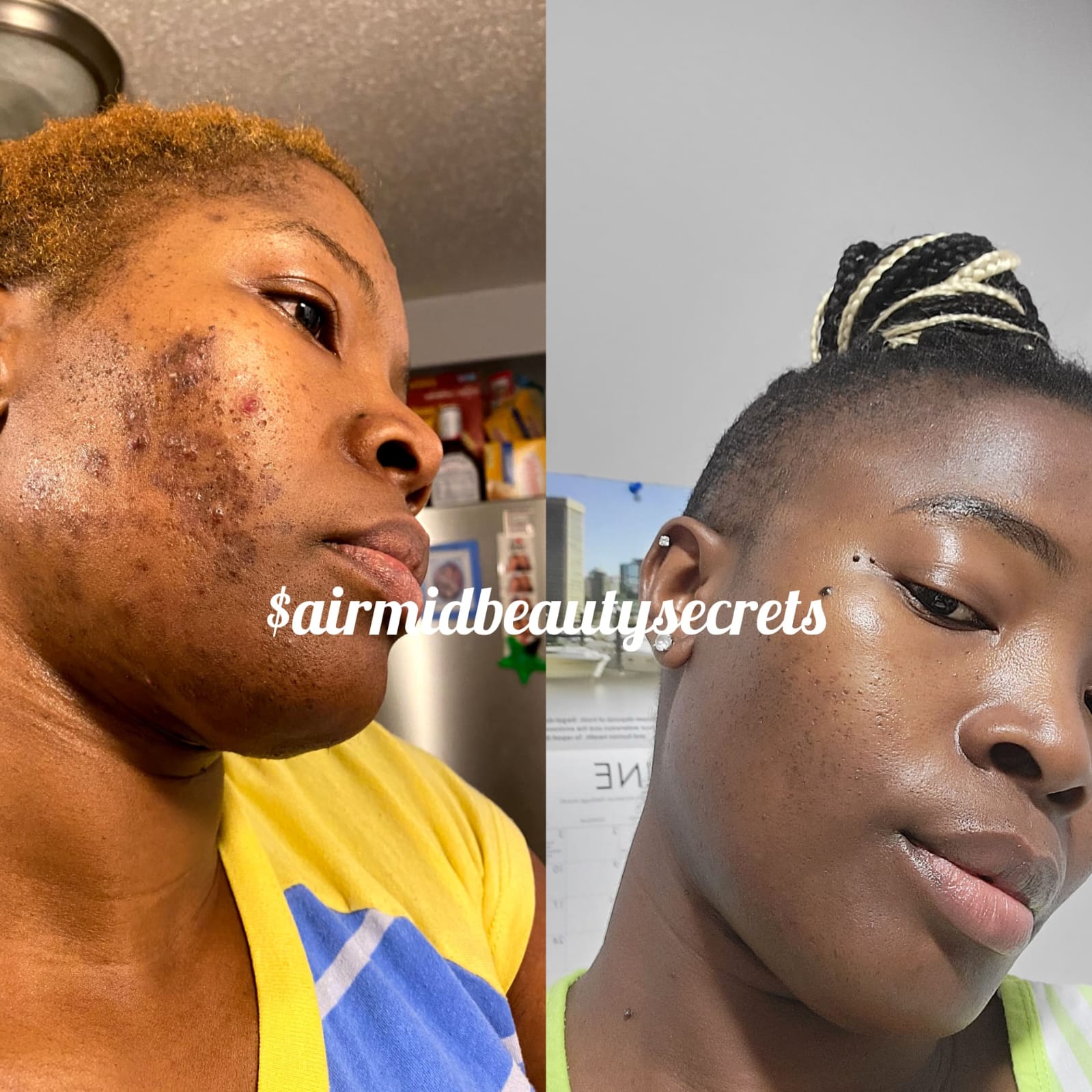 Kojic acid soap discount before and after